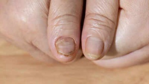Health Alert: Brittle Nails Could Signal Hidden Illnesses – What You Need to Know