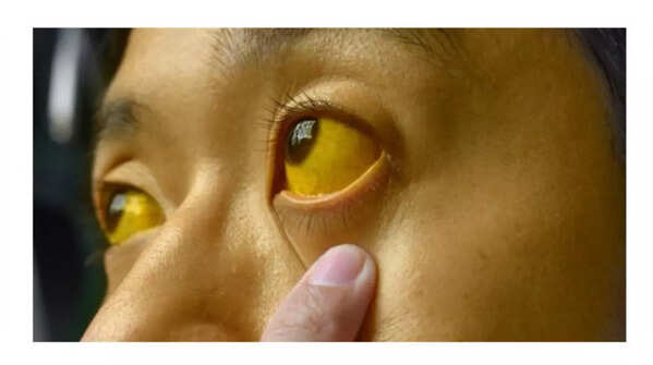 Jaundice