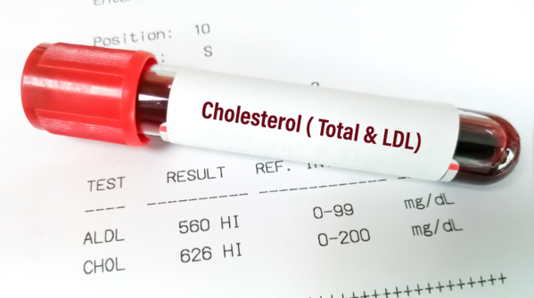 Statins and the memory debate